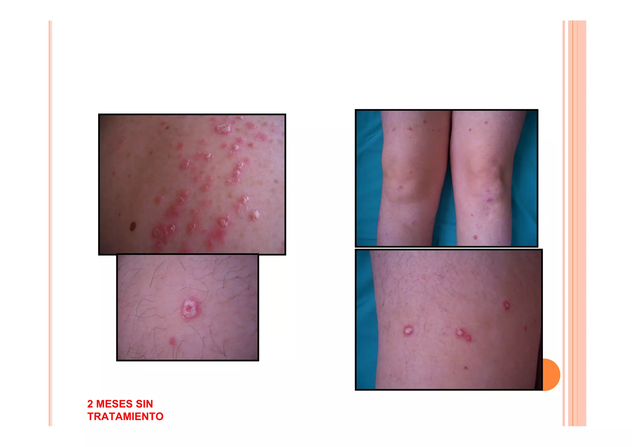 2 MESES SIN
TRATAMIENTO
 