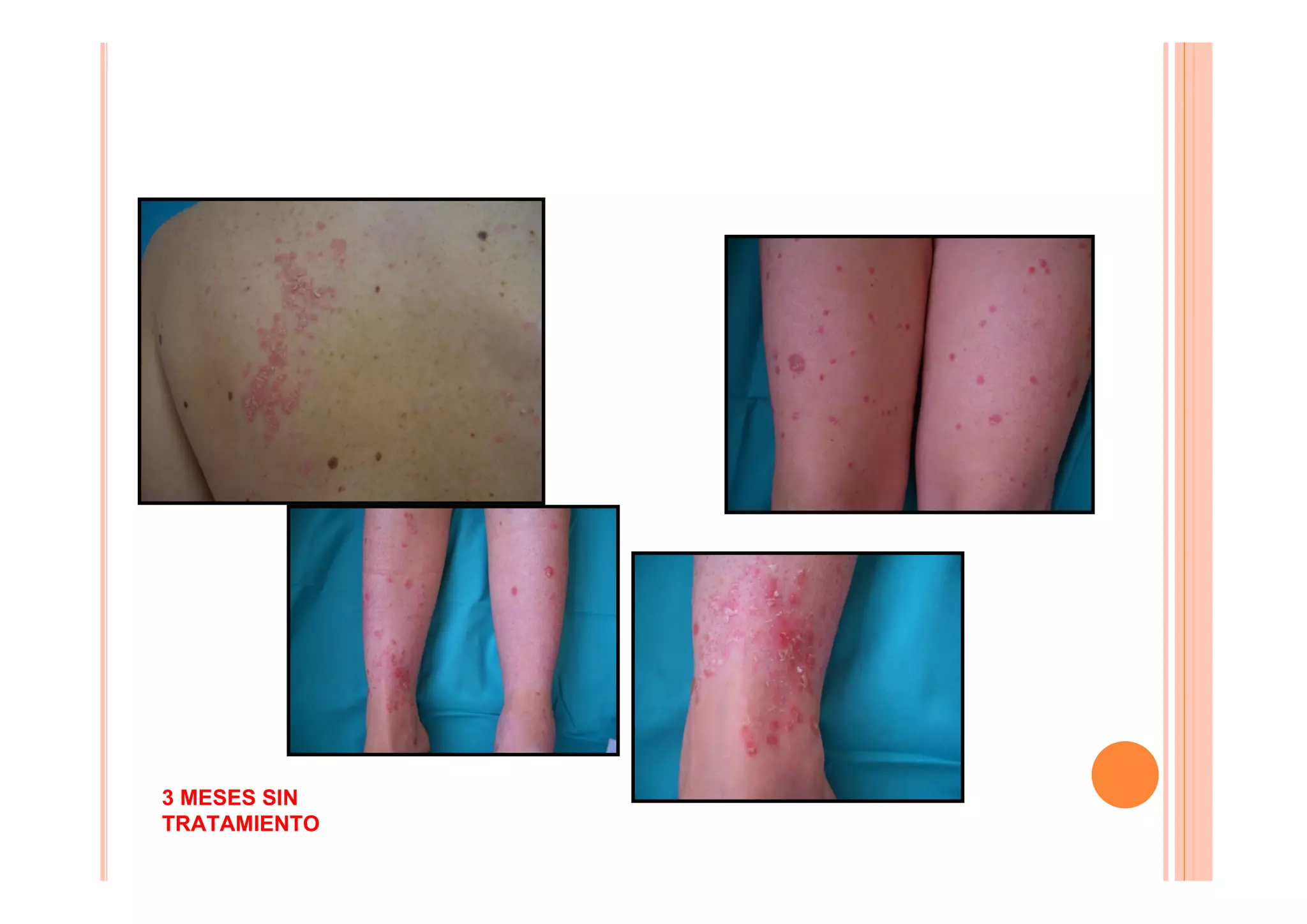 3 MESES SIN
TRATAMIENTO
 