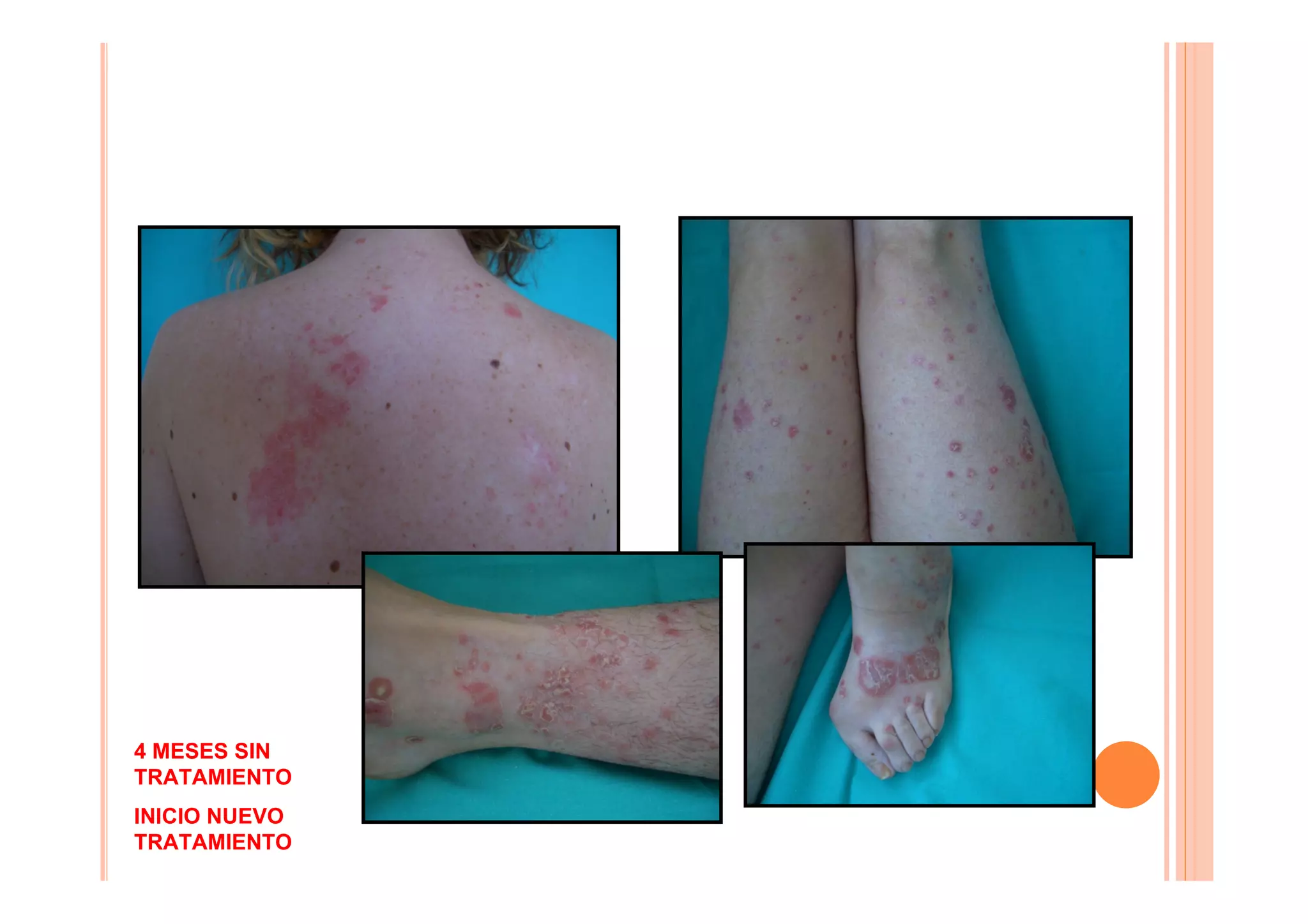 4 MESES SIN
TRATAMIENTO
INICIO NUEVO
TRATAMIENTO
 