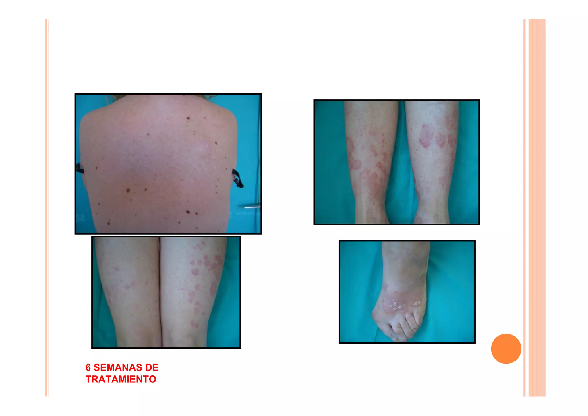 6 SEMANAS DE
TRATAMIENTO
 