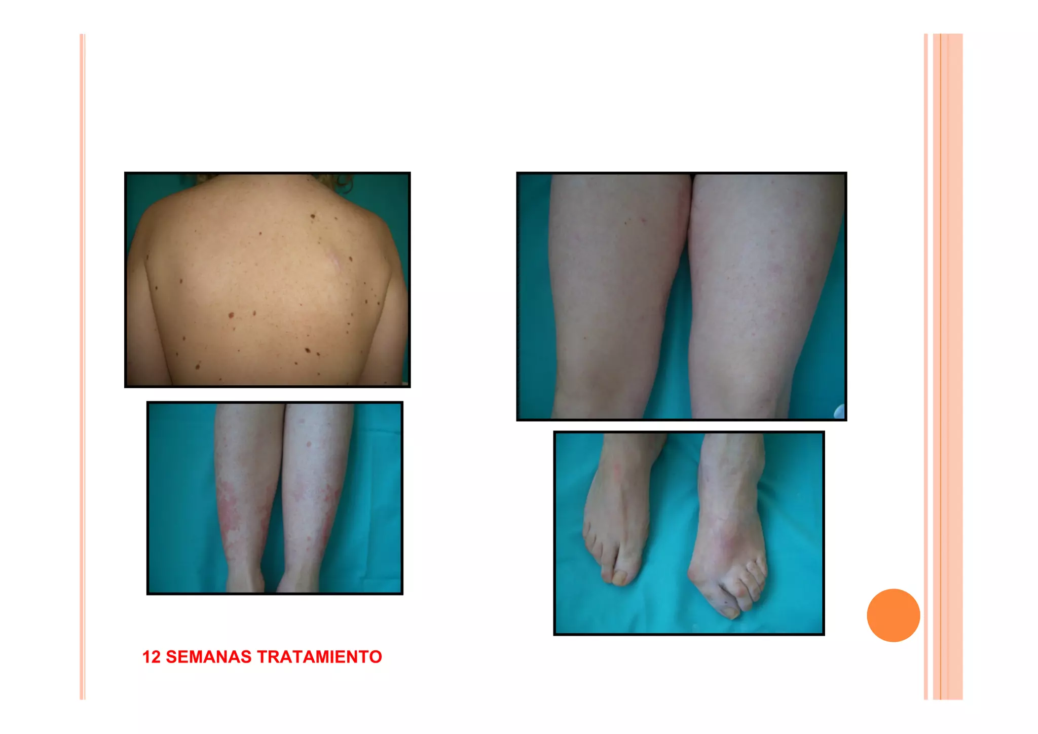 12 SEMANAS TRATAMIENTO
 