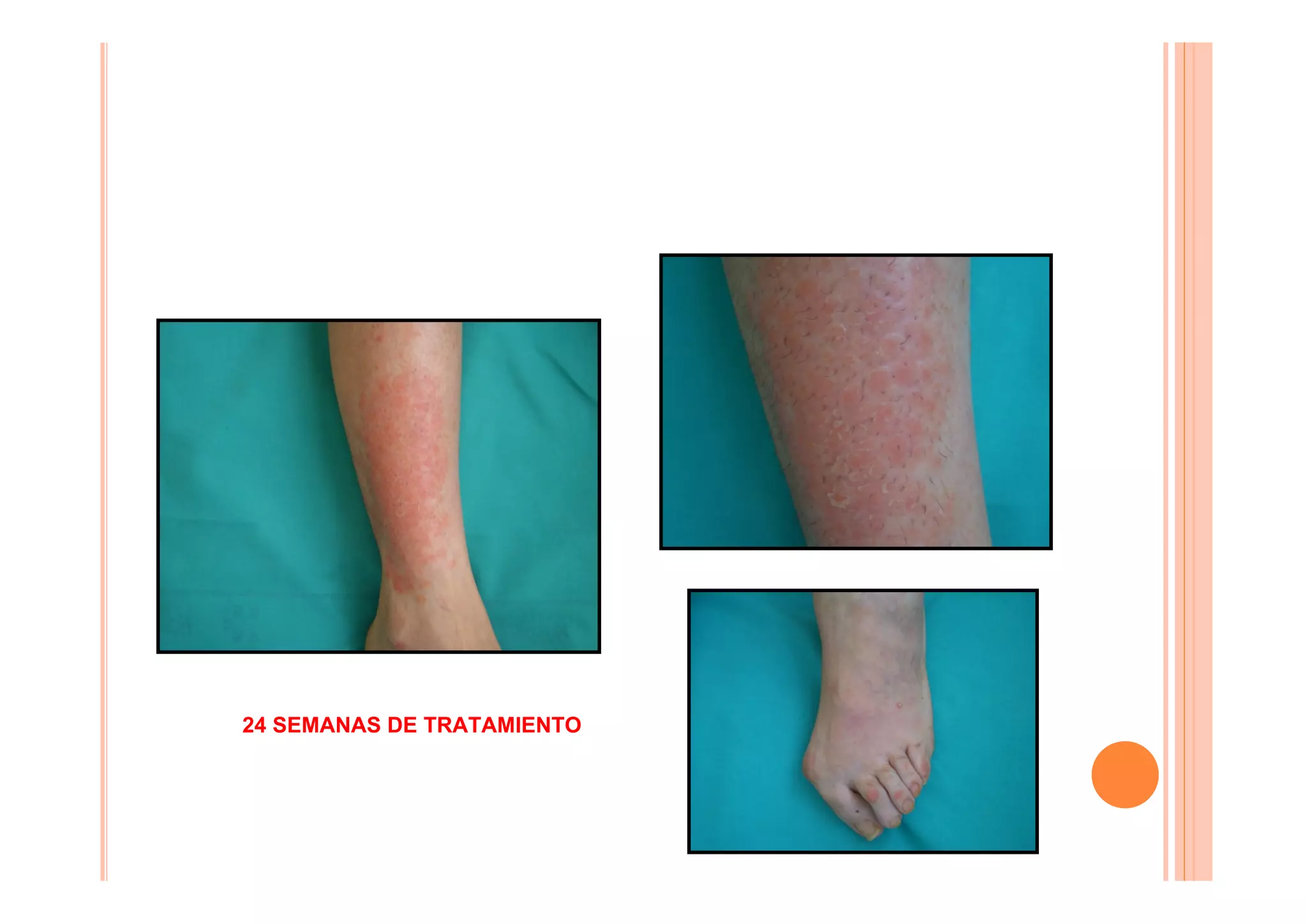 24 SEMANAS DE TRATAMIENTO
 