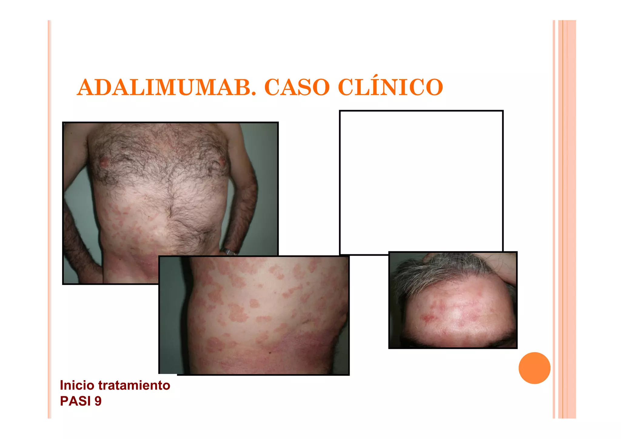 ADALIMUMAB. CASO CLÍNICO




Inicio tratamiento
PASI 9
 