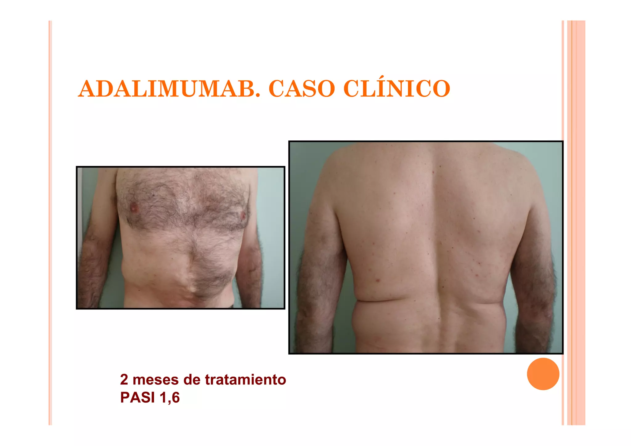 ADALIMUMAB. CASO CLÍNICO




  2 meses de tratamiento
  PASI 1,6
 