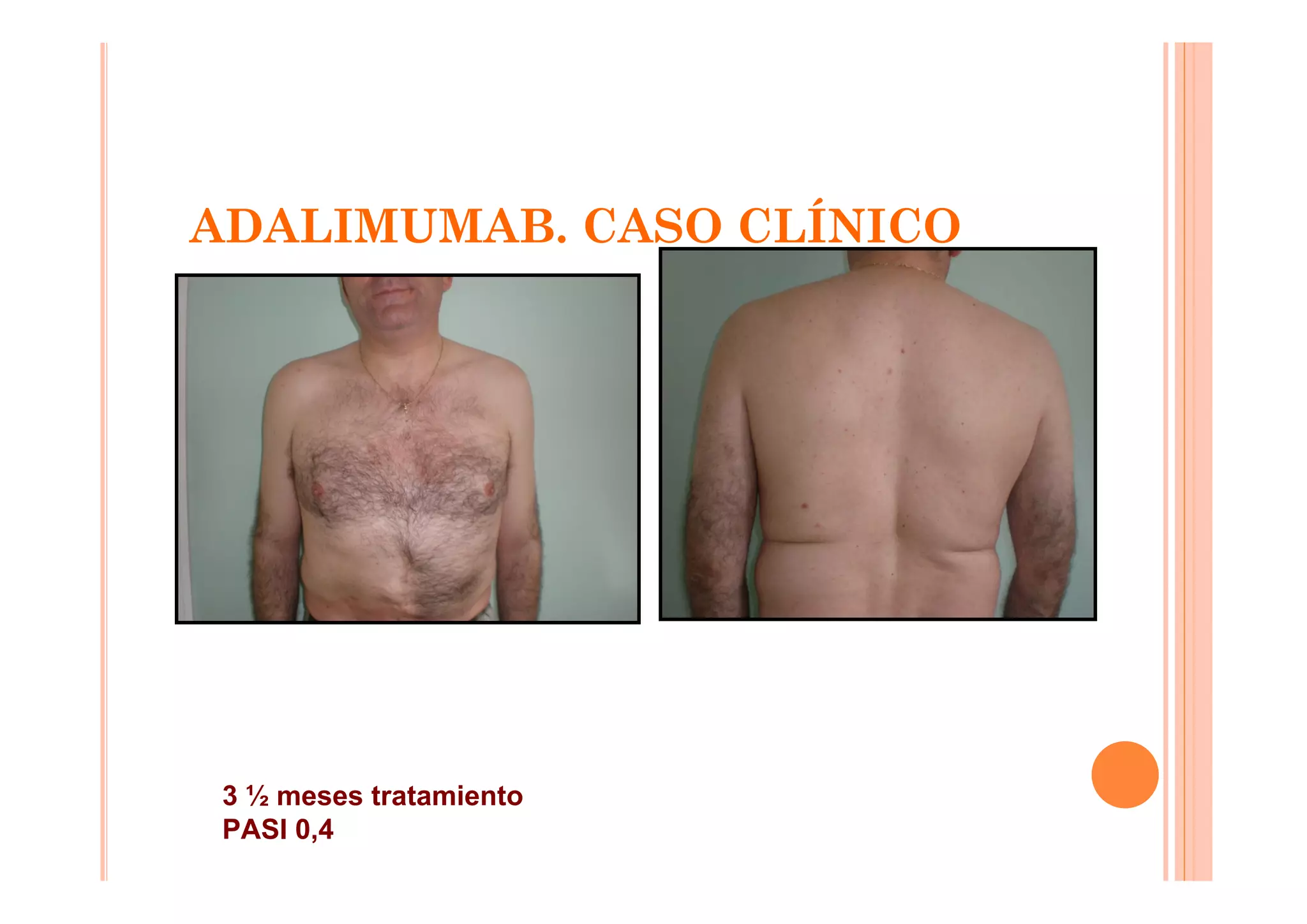 ADALIMUMAB. CASO CLÍNICO




 3 ½ meses tratamiento
 PASI 0,4
 