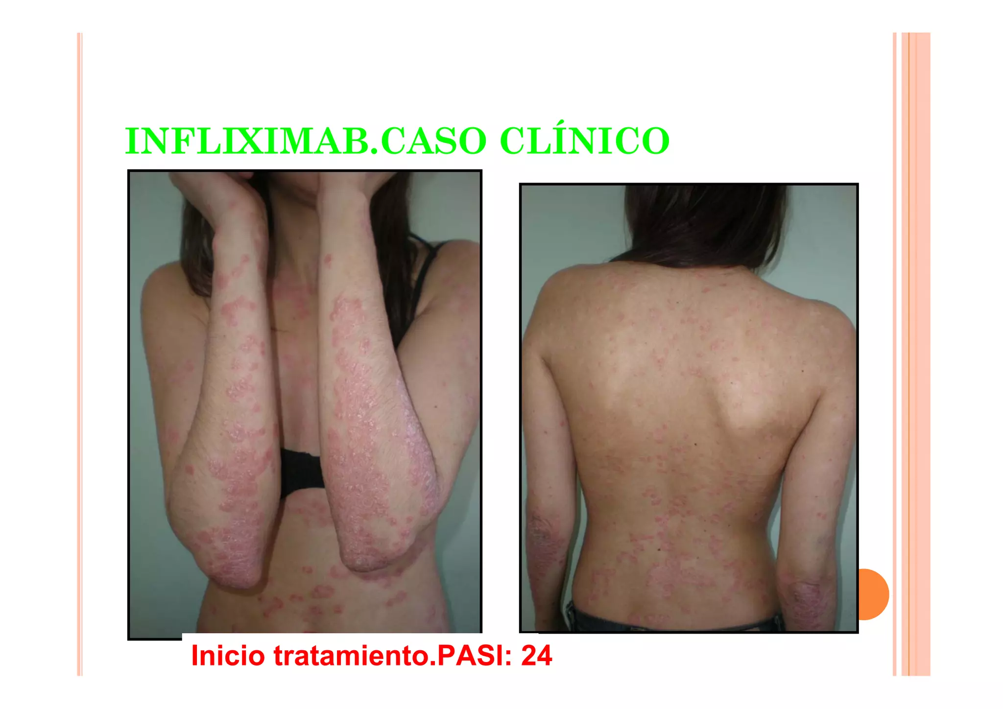 INFLIXIMAB.CASO CLÍNICO




  Inicio tratamiento.PASI: 24
 