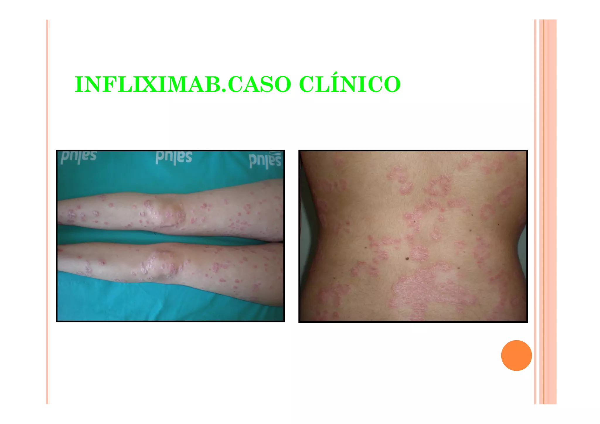 INFLIXIMAB.CASO CLÍNICO
 