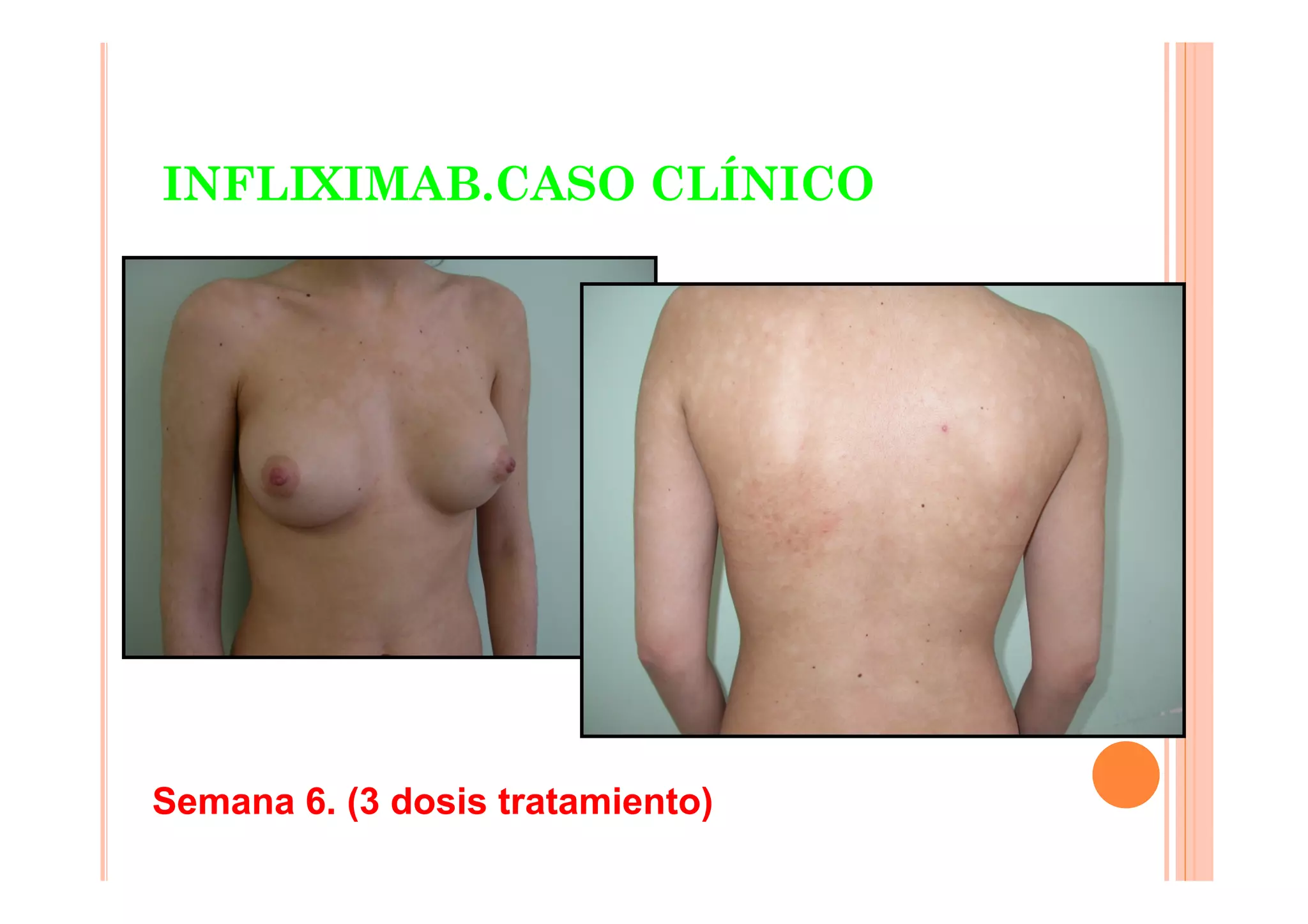 INFLIXIMAB.CASO CLÍNICO




Semana 6. (3 dosis tratamiento)
 