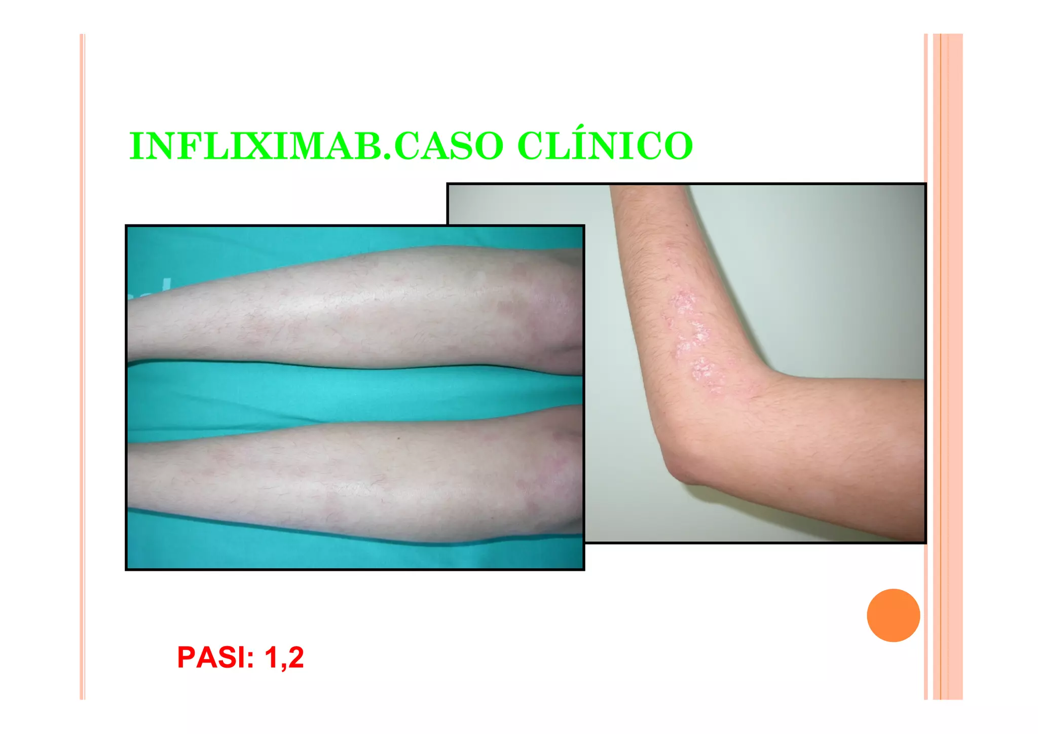 INFLIXIMAB.CASO CLÍNICO




 PASI: 1,2
 