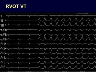 RVOT VT
I
II
III
aVR
aVL
aVF
V1
V2
V3
V4
V5
V6
 