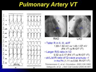 Pulmonary Artery VT
 