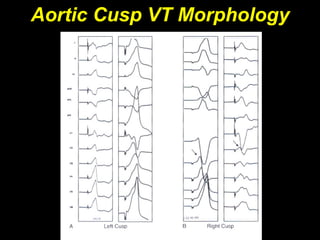 Aortic Cusp VT Morphology
 
