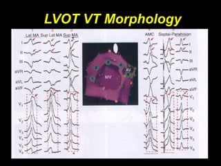 LVOT VT Morphology
 