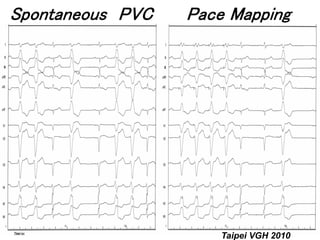 Spontaneous PVC   Pace Mapping




                      Taipei VGH 2010
 