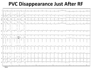 PVC Disappearance Just After RF 
 