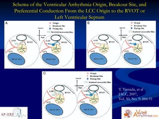 Schema of the Ventricular Arrhythmia Origin, Breakout Site, and
 Preferential Conduction From the LCC Origin to the RVOT or
                    Left Ventricular Septum




                                                 T. Yamada, et al
                                                 JACC, 2007,
                                                 Vol. 50, No. 9: 884-91
 