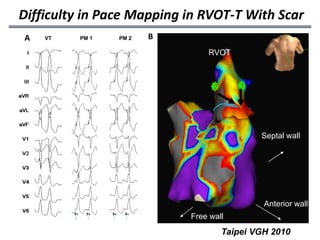 Difficulty in Pace Mapping in RVOT‐T With Scar
A   VT   PM 1   PM 2   B
                               RVOT



                                 2       1




                                             Septal wall




                                              Anterior wall
                           Free wall
                                     Taipei VGH 2010
 