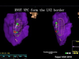 RVOT VPC form the LVZ border




(Higa S: University of the Ryukyus, Okinawa, Japan) 2010
                                         Taipei VGH
 