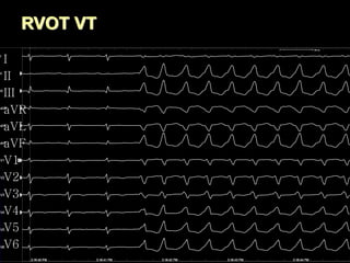 RVOT VT
I
II
III
aVR
aVL
aVF
V1
V2
V3
V4
V5
V6
 