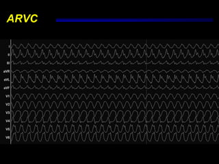 ARVC
 