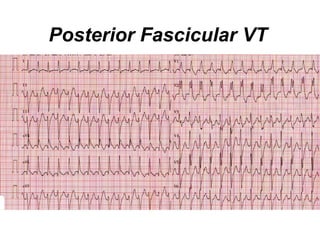 Posterior Fascicular VT
 