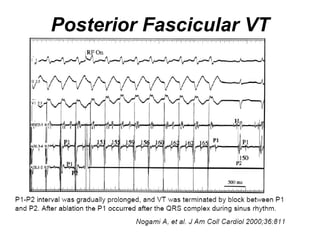 Posterior Fascicular VT
 