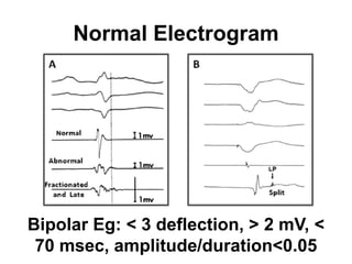 Normal Electrogram




Bipolar Eg: < 3 deflection, > 2 mV, <
 70 msec, amplitude/duration<0.05
 