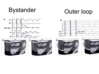 Bystander   Outer loop
 
