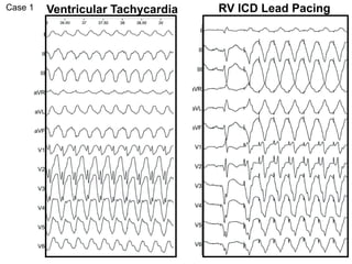 Case 1   Ventricular Tachycardia   RV ICD Lead Pacing
 