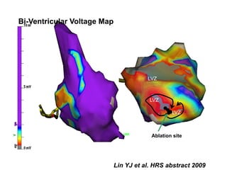 Bi-Ventricular Voltage Map




                                        LVZ



                                         LVZ

                                                 LVZ



                                         Ablation site




                             Lin YJ et al. HRS abstract 2009
 