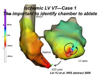 Ischemic LV VT---Case 1
The important to identify chamber to ablate
               RVOT




                  Septum


                                            LV apex


                           ICD Lead
                       Lin YJ et al. HRS abstract 2009
 