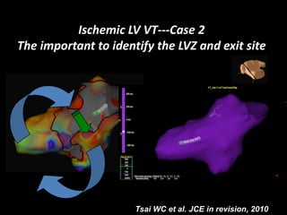 Ischemic LV VT‐‐‐Case 2
The important to identify the LVZ and exit site




                      Tsai WC et al. JCE in revision, 2010
 