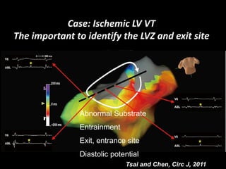Case: Ischemic LV VT 
The important to identify the LVZ and exit site




               Abnormal Substrate
               Entrainment
               Exit, entrance site
               Diastolic potential
                             Tsai and Chen, Circ J, 2011
 