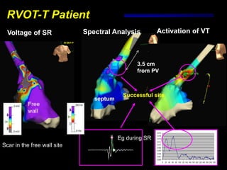 RVOT-T Patient
  Voltage of SR              Spectral Analysis          Activation of VT



                                                3.5 cm
                                                from PV



                                          Successful site
                                septum
           Free
           wall



                                         Eg during SR
Scar in the free wall site
 
