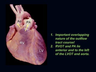 1. Important overlapping
   nature of the outflow
   tract course!
2. RVOT and PA lie
   anterior and to the left
   of the LVOT and aorta.
 