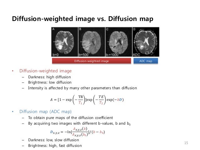 What Is Mri Diffusion Weighted: Diffusion Weighted Mri – ZBBT