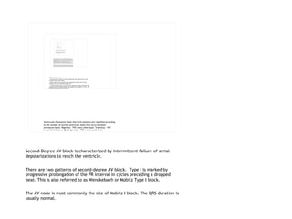 Second-Degree AV block is characterized by intermittent failure of atrial depolarizations to reach the ventricle.  There are two patterns of second-degree AV block.  Type I is marked by progressive prolongation of the PR interval in cycles preceding a dropped beat. This is also referred to as Wenckebach or Mobitz Type I block. The AV node is most commonly the site of Mobitz I block. The QRS duration is usually normal. 