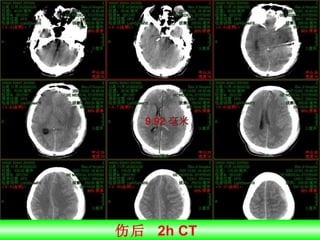 伤后  2h CT  
