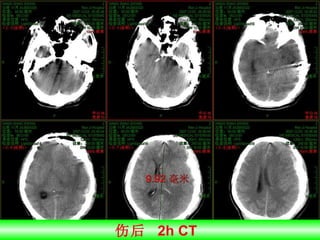 伤后  2h CT  