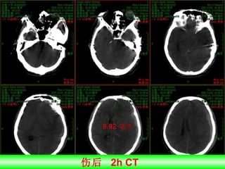 伤后  2h CT  