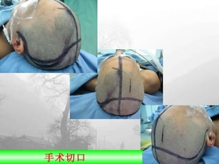 手术切口  