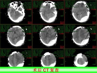术后 CT 复查  