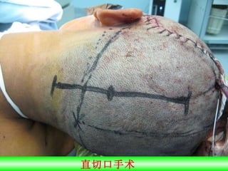 直切口手术  