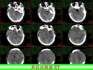 术后出院前 CT  