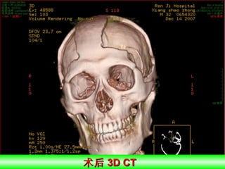 术后 3D CT  