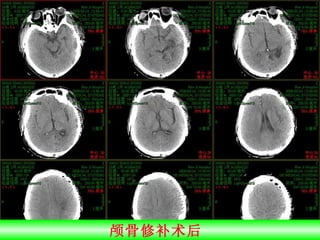 颅骨修补术后  