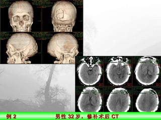 例 2  男性 32 岁，修补术后 CT 
