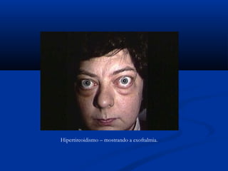 Hipertireoidismo – mostrando a exoftalmia.
 