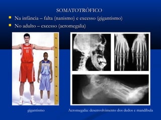 SOMATOTRÓFICO
   Na infância – falta (nanismo) e excesso (gigantismo)
   No adulto – excesso (acromegalia)




          gigantismo         Acromegalia: desenvolvimento dos dedos e mandíbula
 