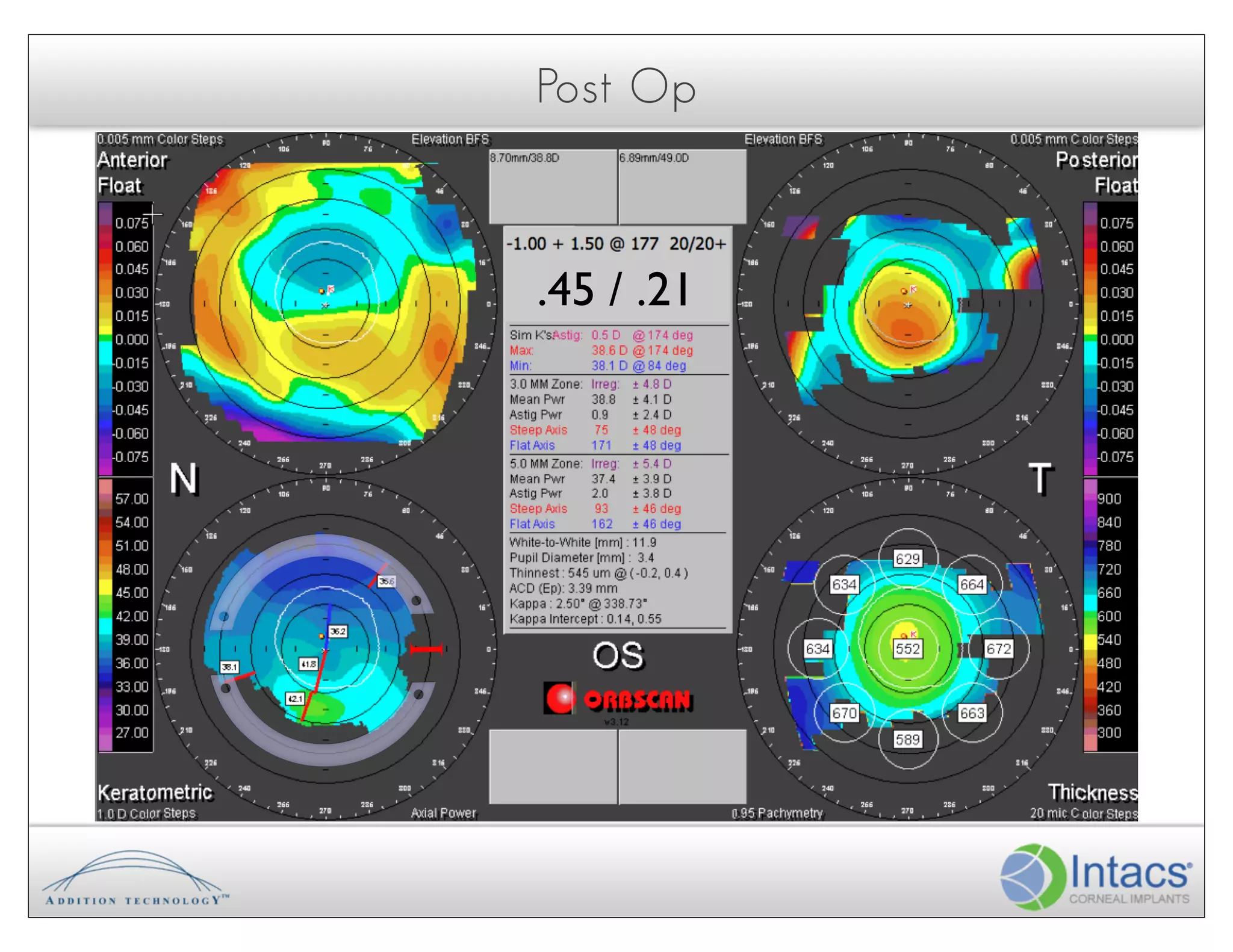 Post Op



     .45 / .21

I!
 
